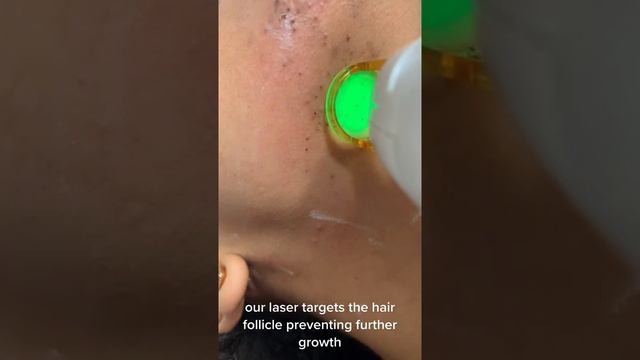 REMOVING BLACKHEADS, BLACKHEADS 2021 NEW, REMOVE & EXTRACT CYSTIC ACNE, MILIA REMOVAL, смотреть онлайн
