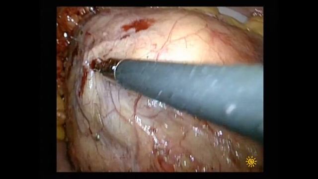 RENAL 11ph Lap partial nephrectomy for hilar tumor/transmesocolic/резекция в воротах почки/транс смотреть онлайн