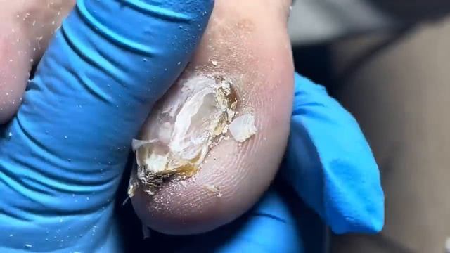 Super long onychomycosis, remove thick nails layer by layer【Pedicure Master Lin Jun】 смотреть онлайн
