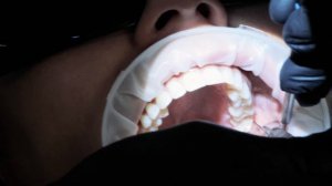 Процесс удаления зуба мудрости