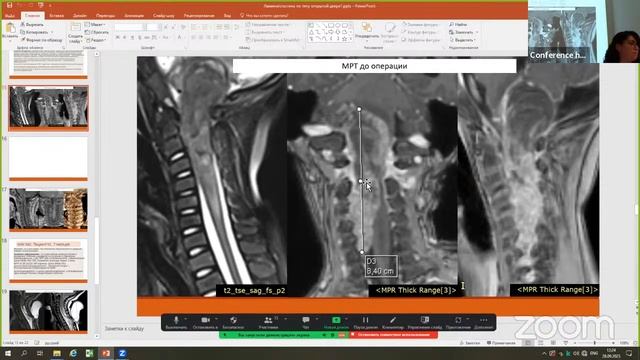Surgical Treatment Of Cervical Spondilogenic Myelopathy Laminoplasty