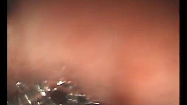 Кишечная метаплазия в желудке Пищевод Барретта смотреть онлайн