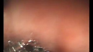 Кишечная метаплазия в желудке Пищевод Барретта