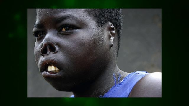 Эксперименты над заражёнными сифилисом в Таскиги! смотреть онлайн