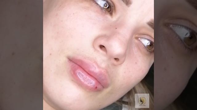 Техники Емелян Брауде, губы ТП смотреть онлайн