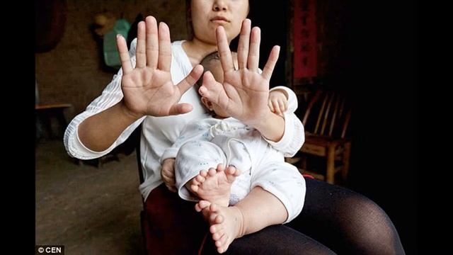 В Китае  родился мальчик с 31 пальцем