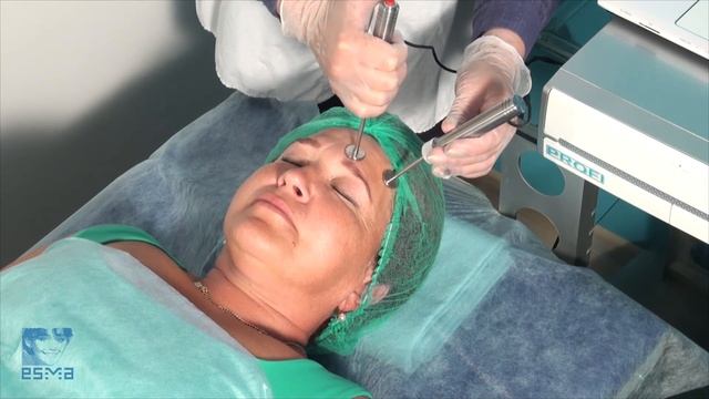 Проведение процедуры изометрии при помощи пробы П3 от компании ЭСМА (часть 1 - лицо)