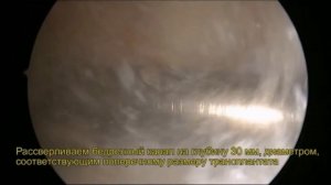 Анатомическая пластика передней крестообразной связки коленного сустава системой RIGIDFIX CURVE