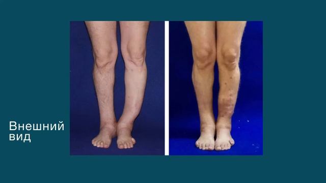 Если перелом неправильно сросся смотреть онлайн