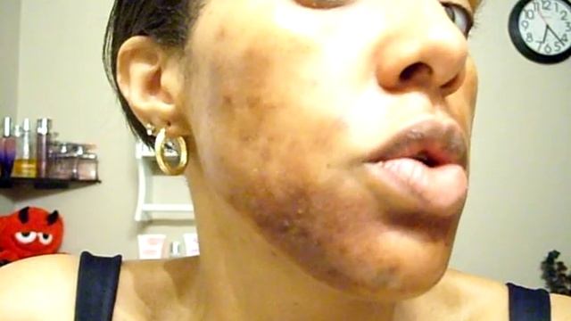 Jessner's Chemical Peel African American- Day 2 смотреть онлайн