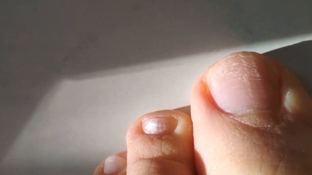 Слоятся ногти на ногах