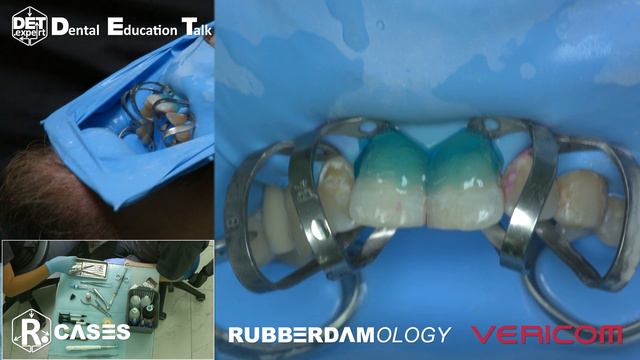 Травление тканей зуба #Rubberdamology #Vericom #Etching Case 13 #8kdcv #8K смотреть онлайн