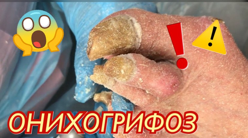 ОНИХОГРИФОЗ?⚠️?❗️??