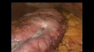 Лапароскопическое мини-гастрошунтирование