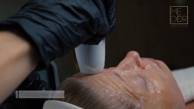 Ультразвуковой SMAS лифтинг LIFTERA