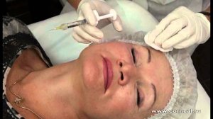 Биоревитализация области вокруг глаз