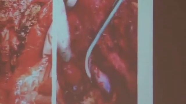 Щерба А.Е. Трансплантационные технологии в высокотехнологичной хирургии смотреть онлайн