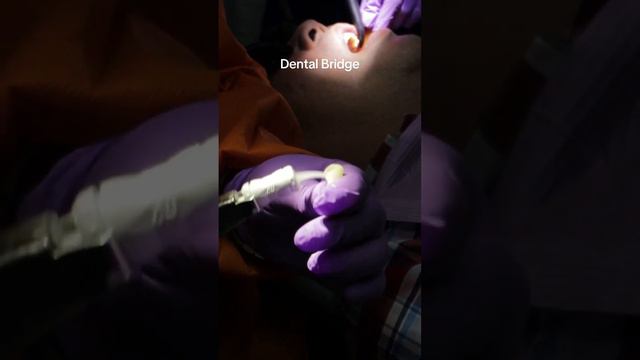 Redoing dental Bridge #dental #dentistry #digitalsmiledesign смотреть онлайн