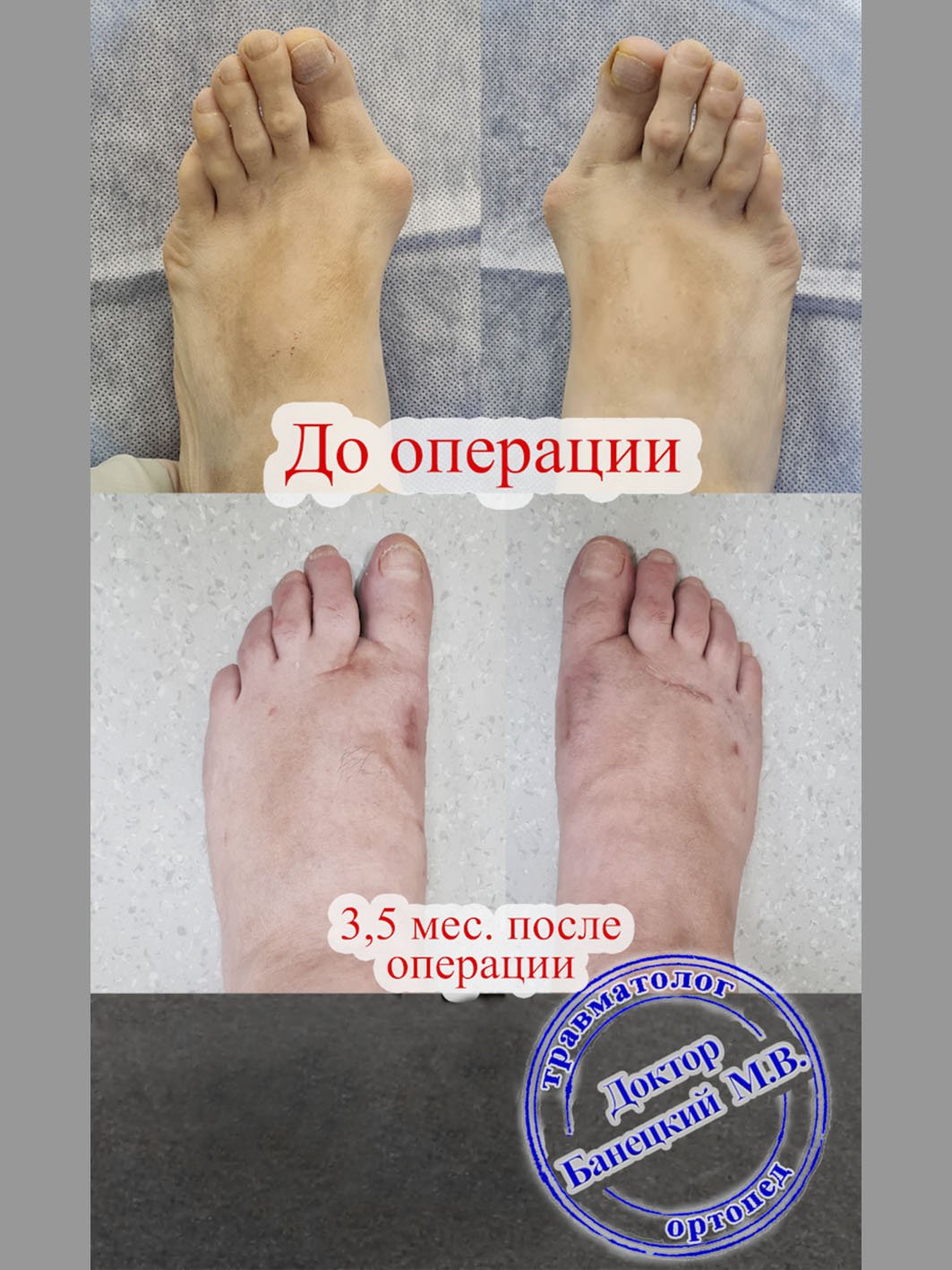 Отзыв пациентки через 3,5 мес. после операции  по поводу  шишек на стопах