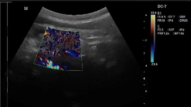 Кинкинг ВСА