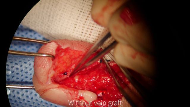 Replantation Of Degloving Avulsion Amputation