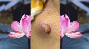 Выдавливание чёрных точек НОВОЕ! Удаление чёрных точек за ухом. p21