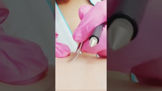 Электроэпиляция , всё там Https://t.me/y_syutkinoi       #тюмень