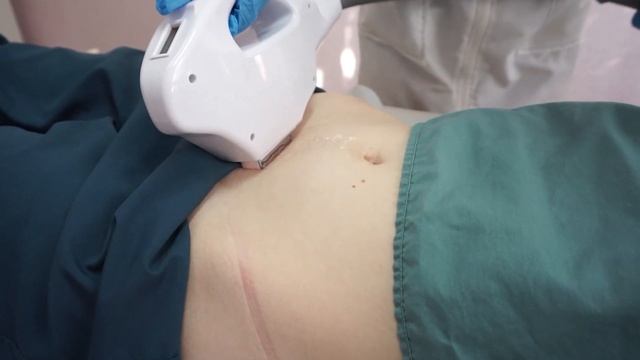 Фотоэпиляция: Приднестровье и Парканы смотреть онлайн