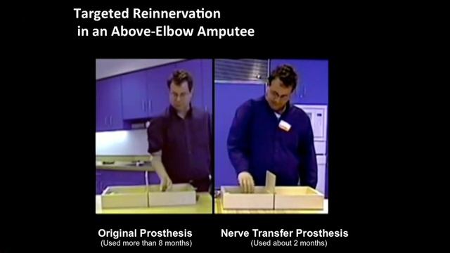 Todd Kuiken: A prosthetic arm that "feels" смотреть онлайн