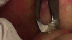 ВЫДАВЛИВАНИЕ ЖИРОВИКОВ И ЧЕРНЫХ ТОЧЕК НА ТЕЛЕ ЧЕЛОВЕКА