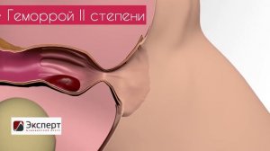 Стадии геморроя. Анимация