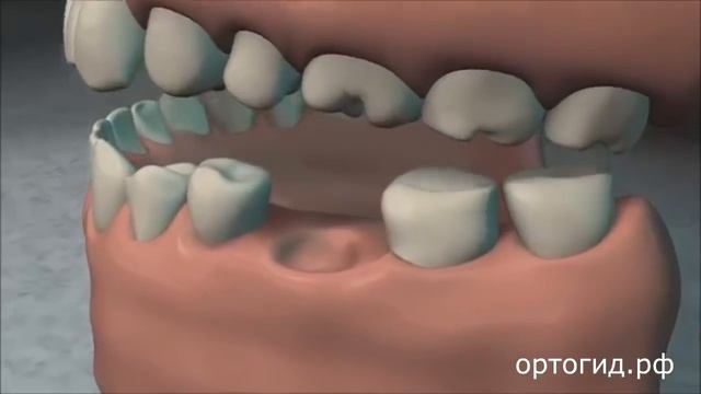 Держатели места. Ортодонтические аппараты. Оrthodontic appliances. Space Maintainers. смотреть онлайн