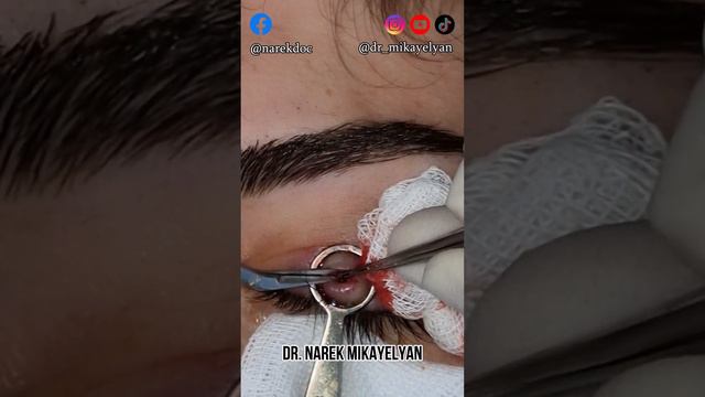 🇺🇲 Chalasion Surgery, 🇦🇲 Խալազիոնի հեռացում🇷🇺 Удаление халязиона смотреть онлайн