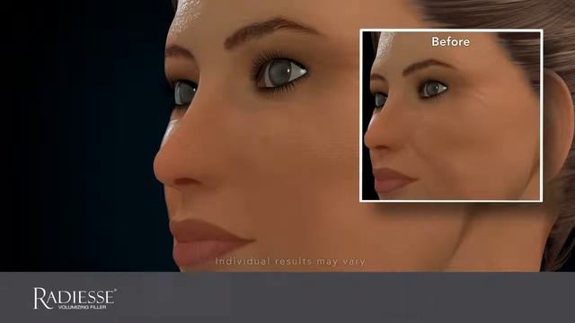 Radiesse Volumizing Filler @ Skin Perfect Brothers Walnut, CA смотреть онлайн