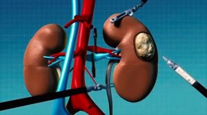 Резекция почки: удаление рака с сохранением органа