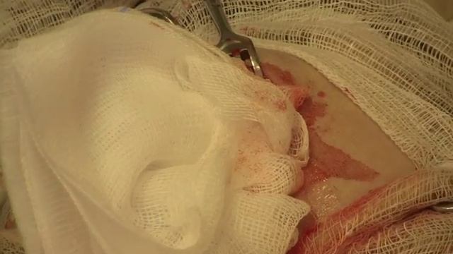 Болезнь Пертеса. Резекция бедренной кости. смотреть онлайн