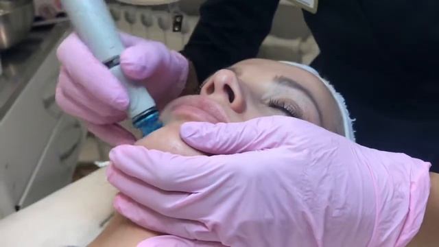 Вакуумная чистка лица на аппарате Hydrafacial смотреть онлайн