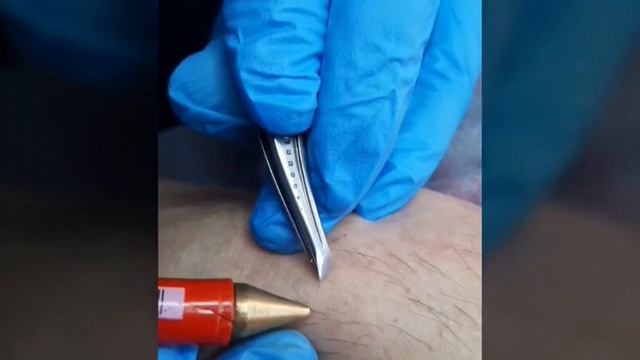 ? УДАЛЕНИЕ ВОЛОС НАВСЕГДА смотреть онлайн