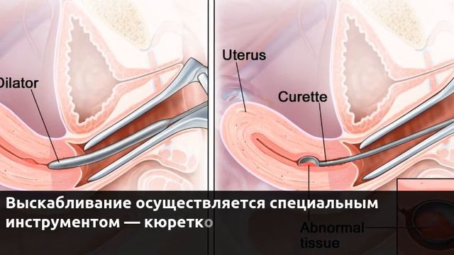 Диагностическое выскабливание смотреть онлайн