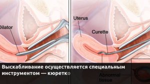 Диагностическое выскабливание