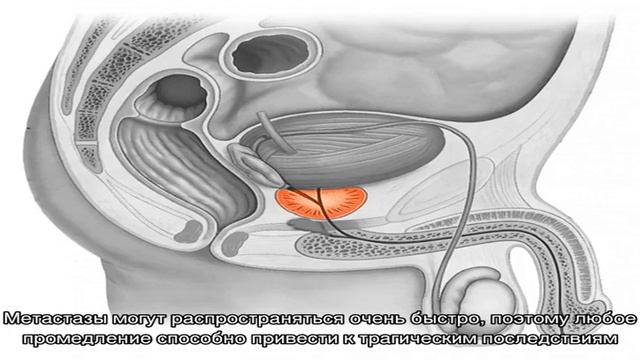 Почему может болеть простата и что с этим делать?