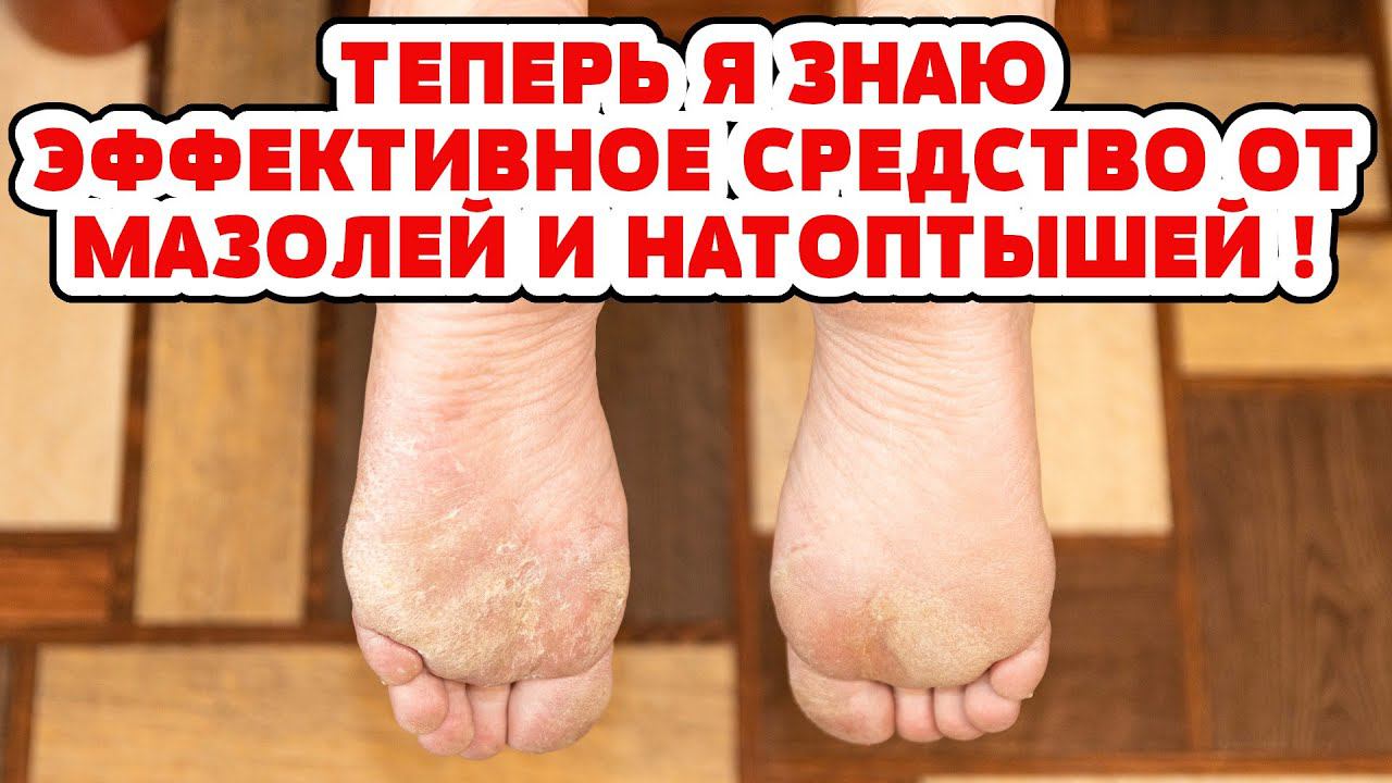 2 СРЕДСТВА из АПТЕКИ и вы забудете про Натоптыши, Сухие мозоли, Трещины на пятках! Простой рецепт смотреть онлайн