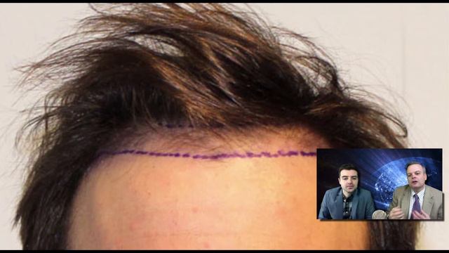Hair Transplant in Play-by-Play format #1 - Feller and Bloxham-Great Neck, NY смотреть онлайн