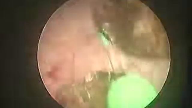 литотрипсия лазером в Севастополе mp4 смотреть онлайн