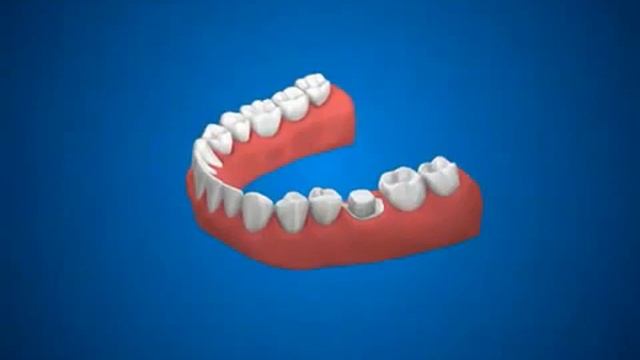 Как устанавливают коронку на зуб