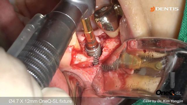 [DENTIS implant] #34 Implant placement with SIMPLE GUIDE Plus & GBR смотреть онлайн