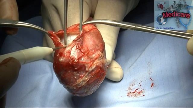 Radical Orchidectomy