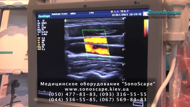 Ультразвуковая диагностика компании SonoScape смотреть онлайн