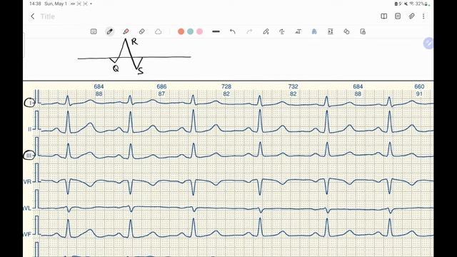 Определение ЭОС по ЭКГ.  4 способа.