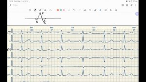 Определение ЭОС по ЭКГ.  4 способа.